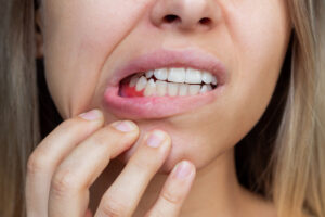 Diş eti iltihabı belirtileri — Özel Family Dent Bornova periodontoloji