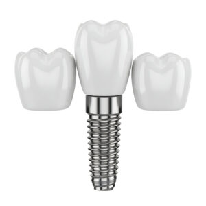 Buca diş implantı