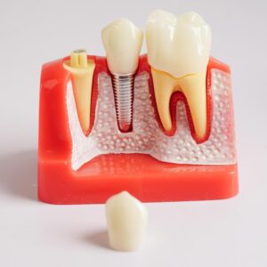 Çiğli implant uygulaması