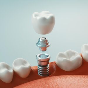 Konak implant kontrolü